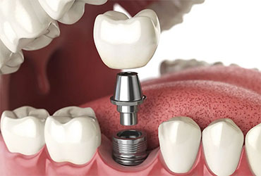 Dental Implants at Pathivara Dental Clinic Beltar Udayapur