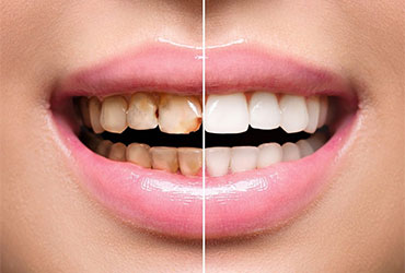 Dental Restoration at Pathivara Dental Clinic Beltar Udayapur