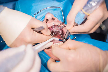 Dental Surgery at Pathivara Dental Clinic Beltar Udayapur
