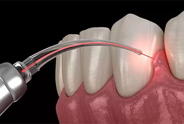 Gum Treatment at Pathivara Dental Clinic Beltar Udayapur