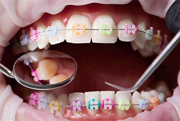 Orthodontics at Pathivara Dental Clinic Beltar Udayapur