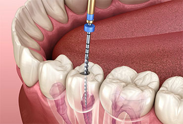 Root Canal Treatment at Pathivara Dental Clinic Beltar Udayapur