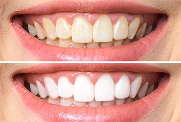 Teeth Whitening at Pathivara Dental Clinic Beltar Udayapur